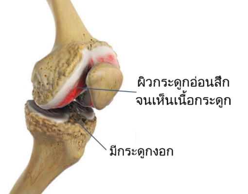 โรคข้อเข่าเสื่อม คืออะไร?